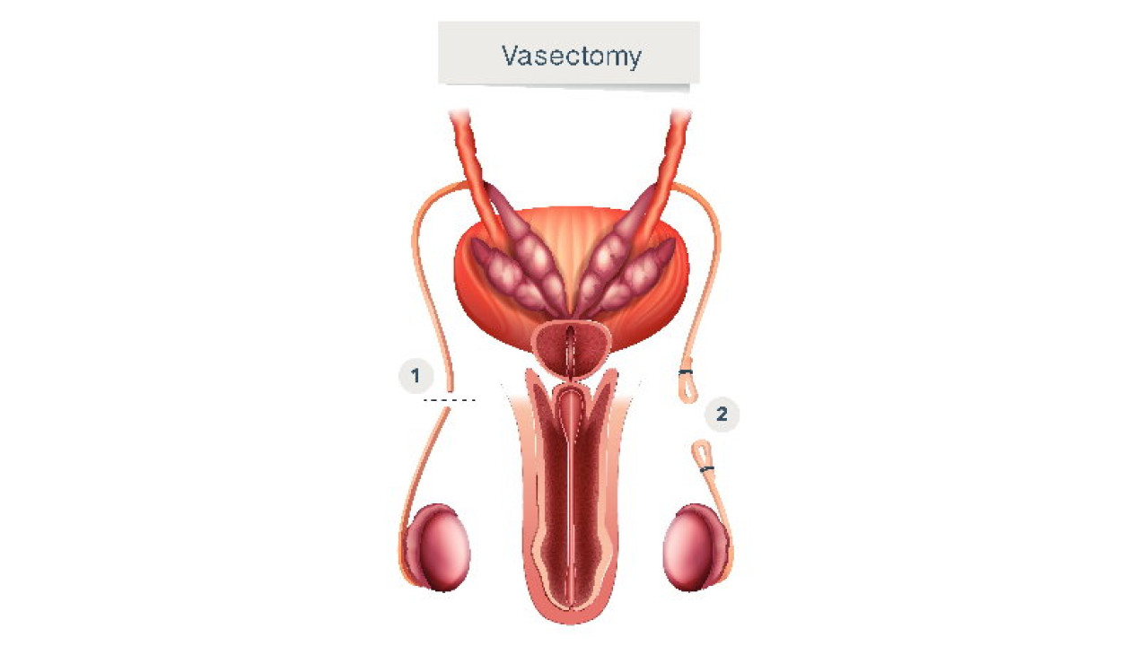 Vasektomie, Artikelbild